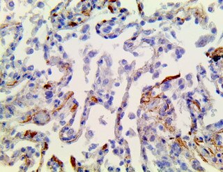 IHC of SARS-CoV-2 on a FFPE SARS-CoV-2 Infected Lung Tissue