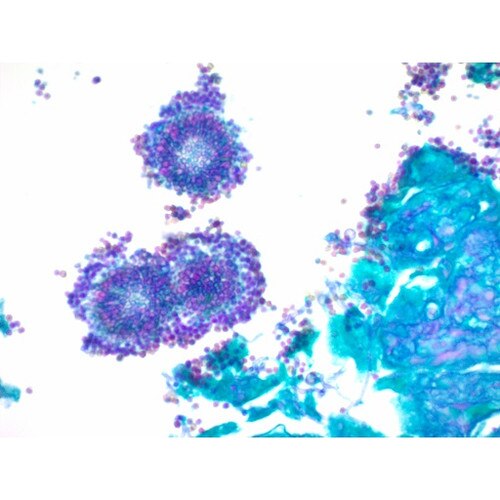 Periodic Acid Schiff PAS Stain Kit for fungus
