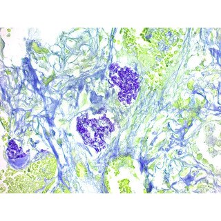 Pneumocystis Carinii Stain Kit