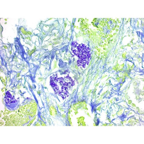 Pneumocystis Carinii Stain Kit