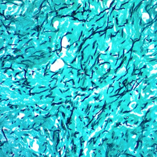 GMS Stain Kit on Lung (Modified Gomori's) SS1046-VO
