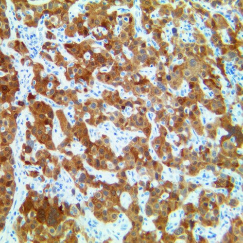 p16, RMab [RBT-p16] IHC on Lung Squamous Cell Carcinoma Tissue