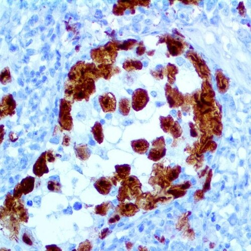 IHC of ALK/CD246 on a FFPE Anaplastic Large Cell Lymphoma Tissue