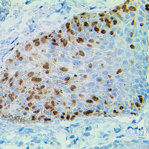 IHC of CK7 on Frozen Mohs Extramammary Paget’s Disease Tissue (DAB HRP Brown)