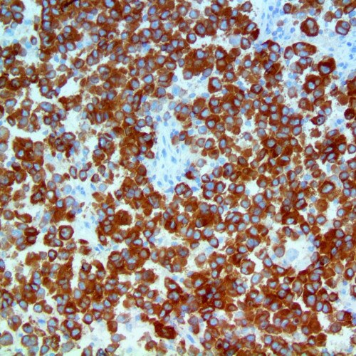 IHC of MART-1 on Frozen Mohs Melanoma (DAB HRP Brown)