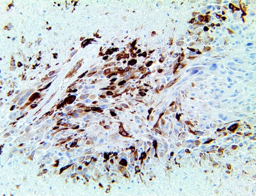 IDH1 Antibody Immunohistochemistry on an FFPE Glioblastoma Tissue