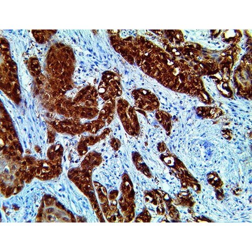 IHC of p16 on a FFPE Mucoepidermoid Carcinoma Tissue