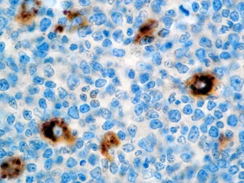 IHC of Alpha-1-Antitrypsin on a FFPE Bladder Tonsil Tissue