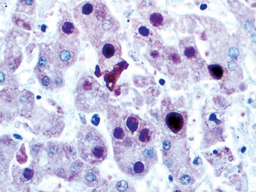 IHC of Adenovirus on an FFPE Infected Liver Tissue