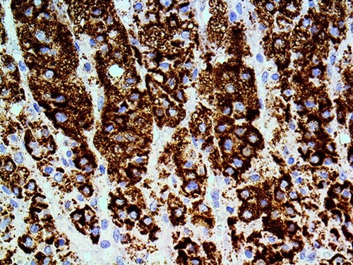 IHC of Adipophilin on an FFPE Squamous Cell Carcinoma Tissue