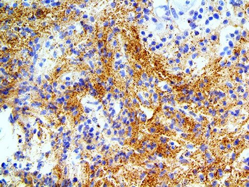 IHC of Alpha Synuclein on a FFPE Astrocytoma Tissue