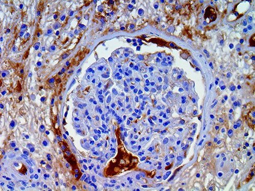IHC of Amyloid A on a FFPE Kidney Tissue