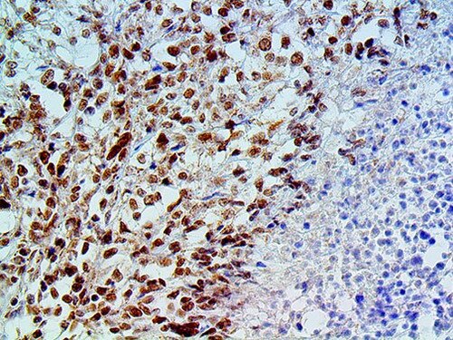 BAP1 Antibody Immunohistochemistry on a FFPE Mesothelioma Tissue