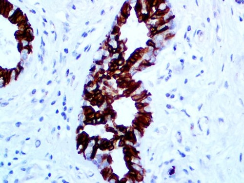 IHC of Bax on an FFPE Hodgkin’s Lymphoma Tissue