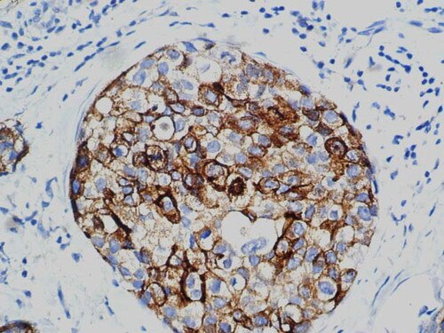 IHC of BCA-225 on an FFPE Breast CarcinomaTissue