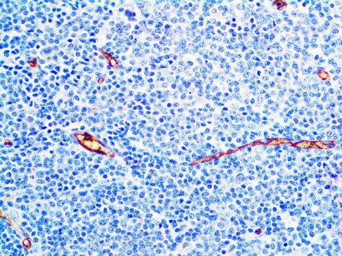IHC of BG8 LewisY on an FFPE Lung Adenocarcinoma Tissue