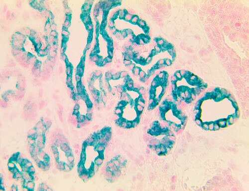 IHC of Mohs PolyDetector Plus HRP Green Detection System staining TintoFast EpCAM BerEP4 on Frozen Mohs SCC
