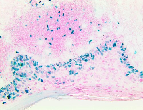IHC of Mohs PolyDetector HRP Green Detection System staining TintoFast Ki-67 on Frozen Squamous Cell Carcinoma Tissue