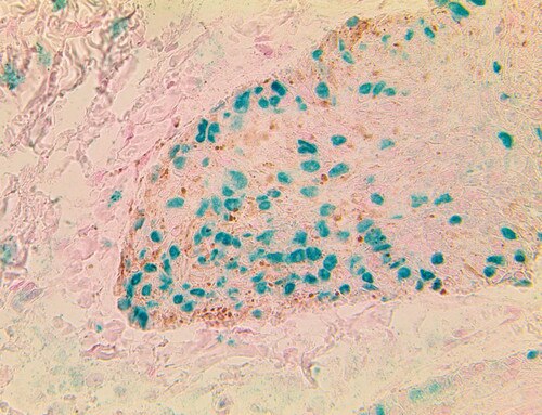 IHC of Mohs PolyDetector Plus HRP Green Detection System staining TintoFast SOX-10 on Frozen Mohs Melanoma