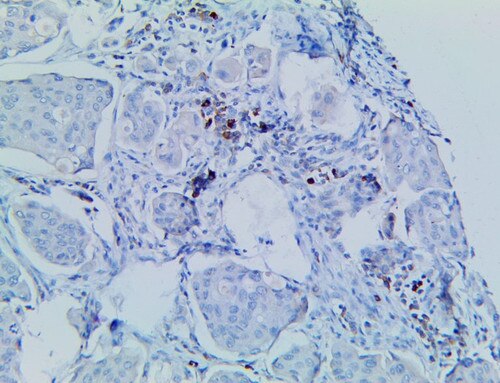 CD137 Antibody Immunohistochemistry on an FFPE Transitional Cell Carcinoma Tissue