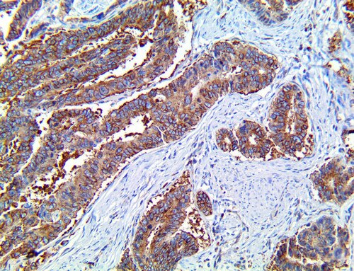 IHC of Laminin-R/RPSA on a FFPE Colon Carcinoma Tissue