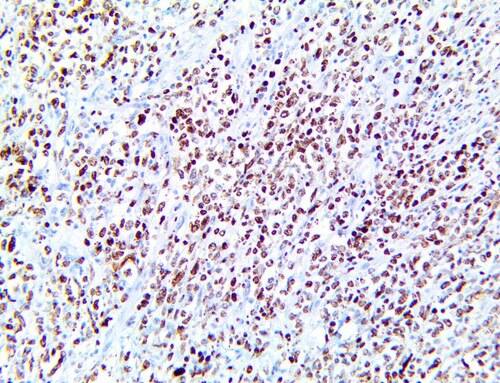 IHC of MNDA on a FFPE Diffuse Large B Cell Lymphoma Tissue