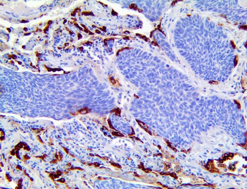 IHC of Surfactant protein D/SP-D on a FFPE Lung Squamous Cell Carcinoma Tissue