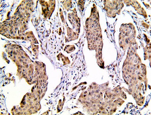 IHC of YAP1 on a FFPE Transitional Cell Carcinoma Tissue