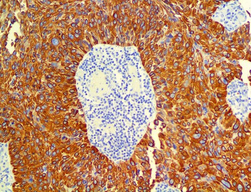 IHC of Cytokeratin 14 on Cervical Cancer Tissue