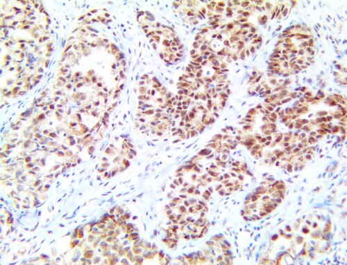 IHC of TDP-43/TARDBP on a FFPE Lung Adenocarcinoma Tissue