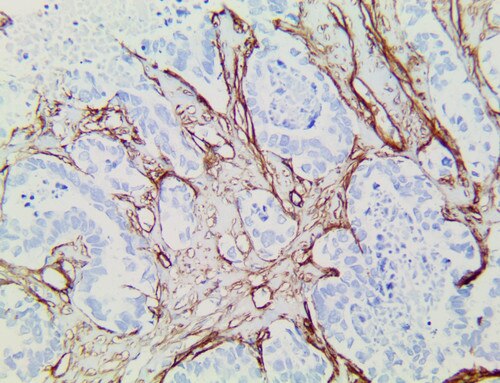 Collagen IV Antibody Immunohistochemistry on an FFPE Lung Adenocarcinoma Tissue
