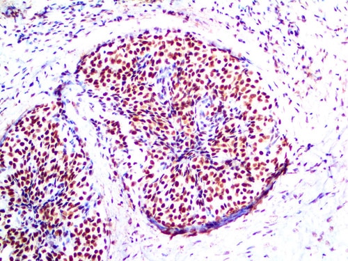 IHC of INI-1 on a FFPE Ewing's Sarcoma Tissue