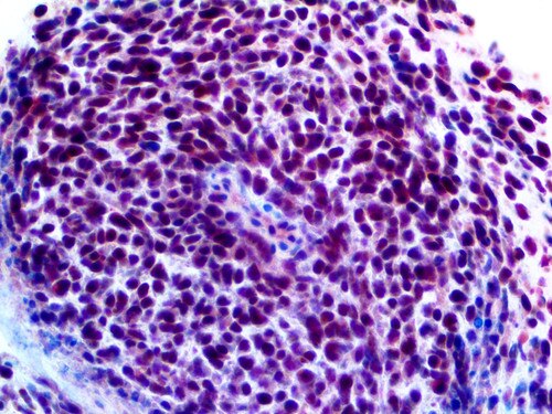 TLE1 Antibody Immunohistochemistry on an FFPE Synovial Sarcoma Tissue