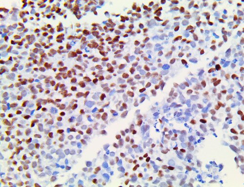 IHC of TLE1 on a FFPE Synovial Sarcoma Tissue