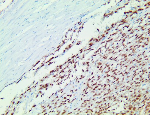 IHC of SS18-SSX on a FFPE Synovial Sarcoma Tissue