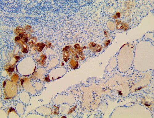 IHC of Calcitonin on a FFPE thyroid with Hashimoto’s Thyroiditis