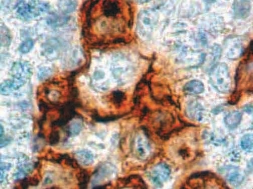 IHC of CD30 on an FFPE Hodgkin’s Lymphoma Tissue