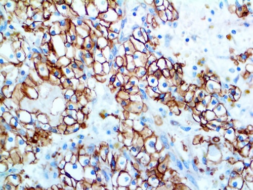 IHC of Carbonic Anhydrase 9 on an FFPE Kidney Tissue