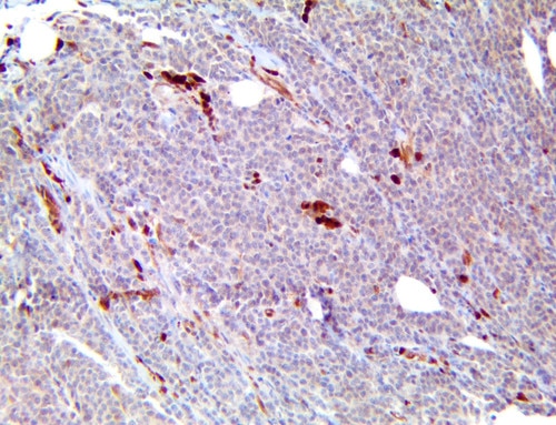 IHC of Caspase-3 on a FFPE HER2-Negative Breast Carcinoma Tissue