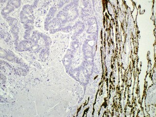 IHC of cytokeratin 7 on an FFPE Lung Carcinoma Tissue