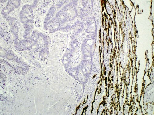 IHC of cytokeratin 7 on an FFPE Lung Carcinoma Tissue