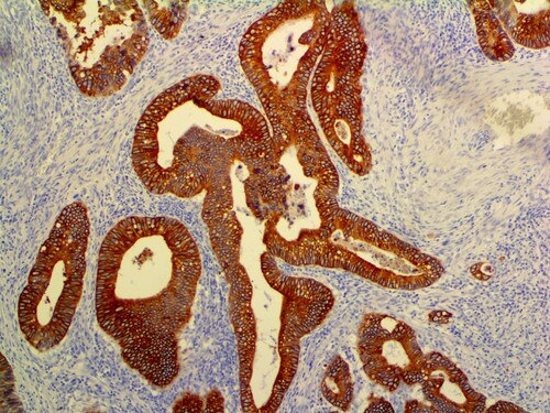 IHC of Cytokeratin 8 & 18 EP30 on an FFPE Colon Carcinoma Tissue