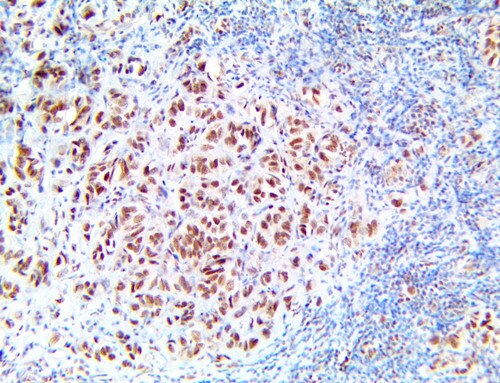 BRG-1 Antibody Immunohistochemistry on an FFPE Ductal Breast Carcinoma Tissue