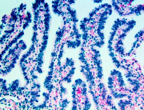 IHC of Estrogen Receptor on Fallopian Tube