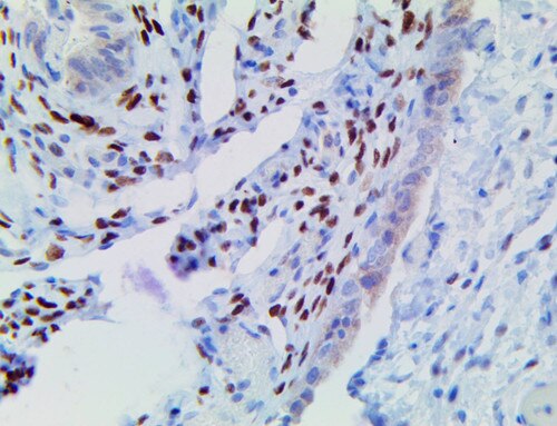 IHC of FOXL2 on a FFPE Fallopian Tube Tissue