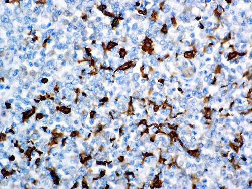 IHC of Fascin on an FFPE Hodgkin’s Lymphoma Tissue