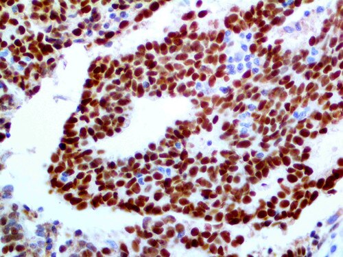 GATA-3 Antibody Immunohistochemistry on a FFPE Breast Carcinoma Tissue