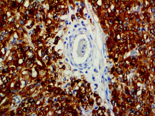 CD117 Antibody Immunohistochemistry on an FFPE GIST Tissue