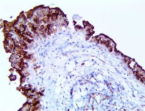IHC of HEG1 on a FFPE Mesothelioma Tissue