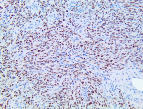 HC of HHV-8 on a FFPE Kaposi's Sarcoma Tissue